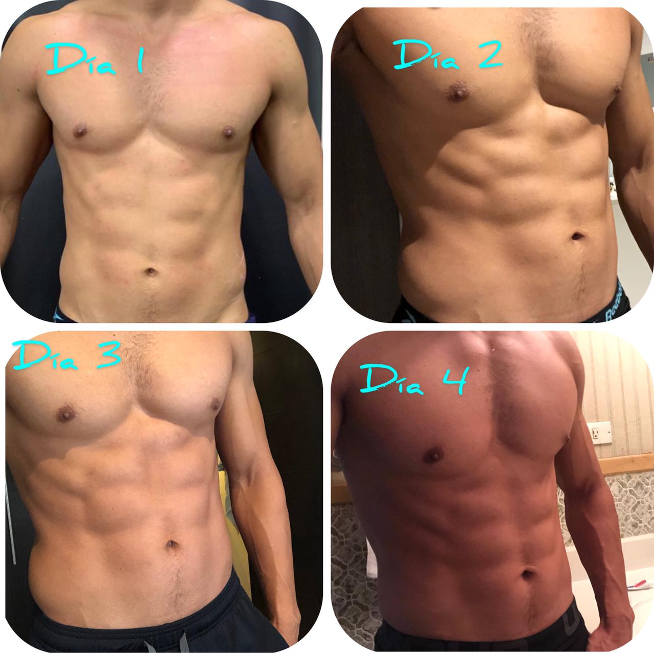 6 packs evolution after endopeel treatment